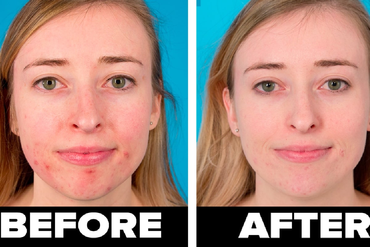 تصویر فردی قبل و بعد از استفاده از ماسک صورت خانگی برای از بین بردن جای جوش و آکنه