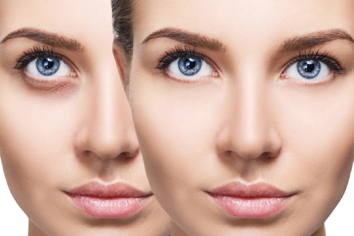 تصویر فردی قبل و بعد از استفاده از ماسک صورت خانگی برای رفع سیاهی دور چشم و لک‌های صورت